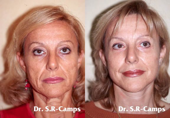 Lifting Facial - Cirugía de rejuvenecimiento facial