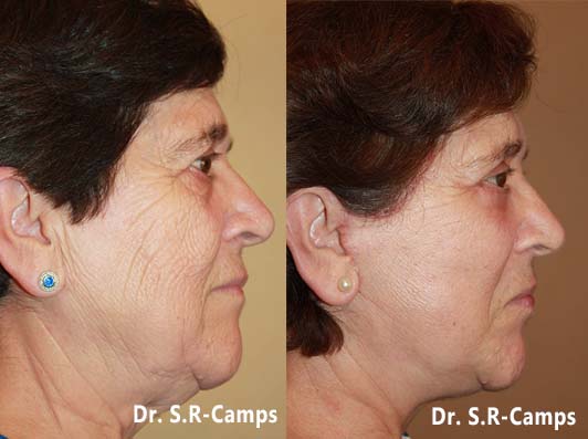 lifting facial antes y despues