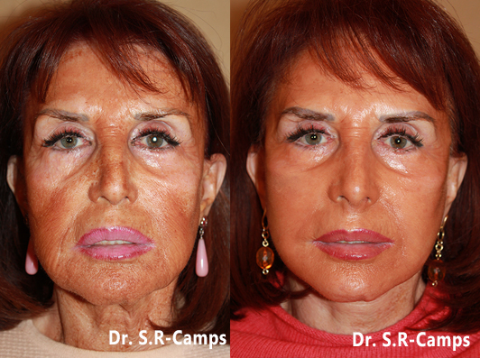 lifting facial antes y despues