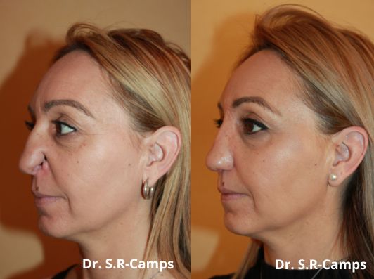 rinoplastia valencia