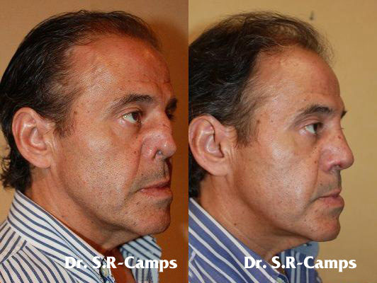 rinoplastia españa rodriguez camps